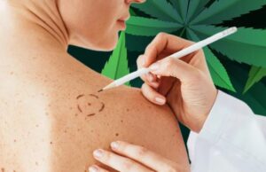 Cannabis May Help Treat Melanoma Skin Cancer, New Study Suggests